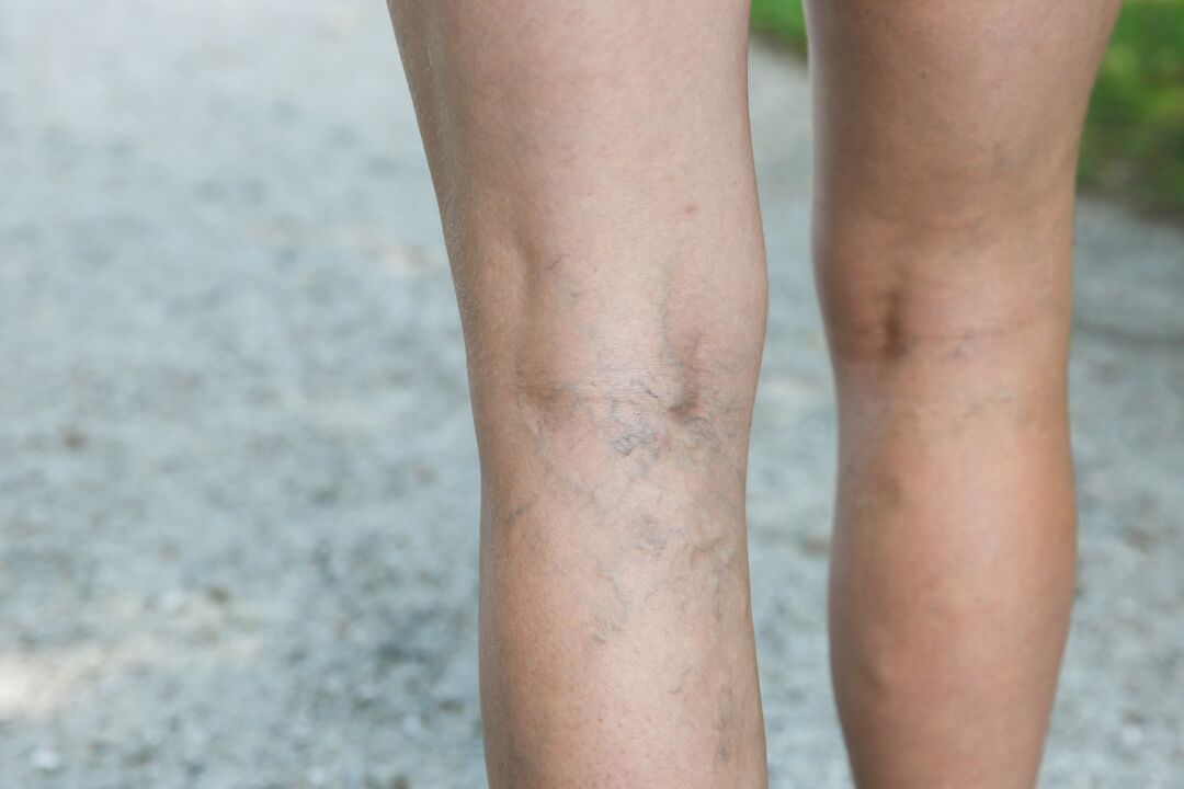 In case of varicose veins, the exercise program should be discussed with your doctor. 